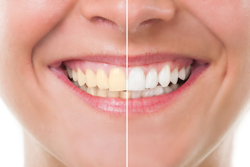 Teeth Whitening in North Venice/Nokomis